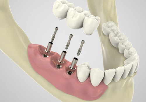 Preparing Your Jawbone for Dental Implant Placement: What You Need to Know