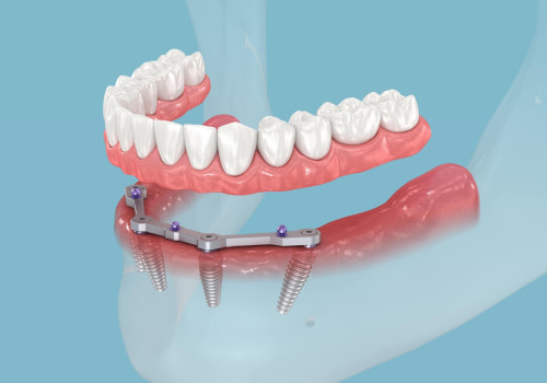 All-on-4 Implants: The Solution for Missing Teeth