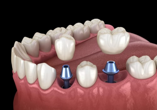 Different Types of Abutments Used for Dental Implants: A Comprehensive Guide