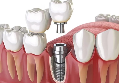 Cleaning and Caring for Dental Implants: A Complete Guide