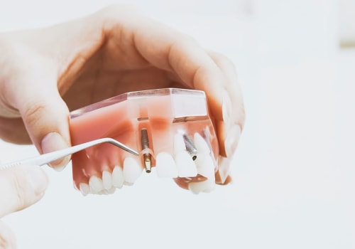 What to Expect During Your Initial Dental Implant Consultation