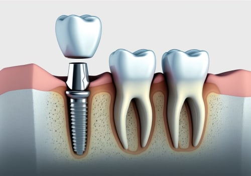 The Benefits of Endosteal Implants