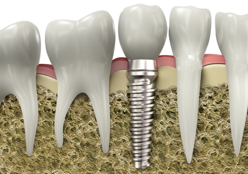 Dietary Changes for Maintaining Healthy Implants: Tips and Tricks to Keep Your Tooth Implants Strong and Functional