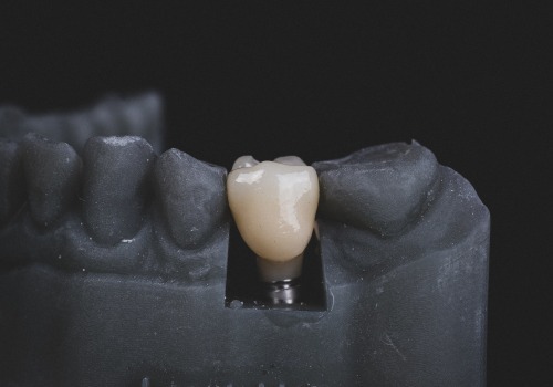 Types of Insurance for Dental Implants